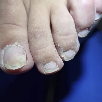 Anastasiya Sherova - Итак, рассмотрим самые частые негрибковые заболевания  ногтей. Лейконехия При лейконехии ногти мутнеют, а также приобретают белый  цвет. Причиной заболевания часто является псориаз или использование не  очень качественных лаков для