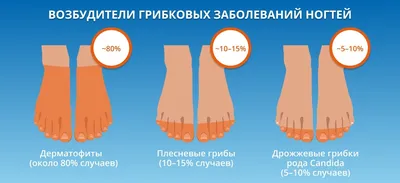 Инфекция кожи, вызвавшая отслойку ногтей у ребенка ✓ Авторские статьи  Клиники подологии Полёт в Москве