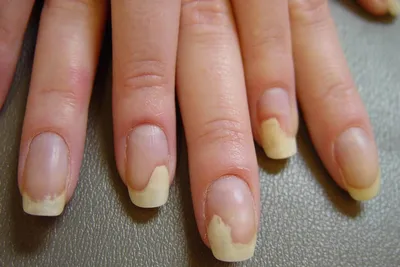 Желтые ногти - причины появления, симптомы заболевания, диагностика и  способы лечения