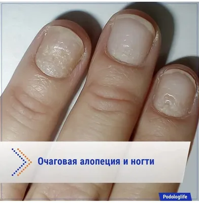 Самые распространенные заболевания ногтей от гель лака. | Лялина Екатерина  | Дзен