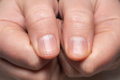 Онихомикоз: симптомы, признаки заболевания, диагностика – лечение  онихомикоза ногтей