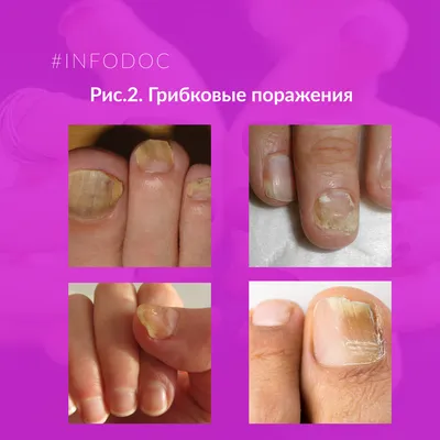 Изменение цвета ногтей — болезни при изменении цвета ногтей