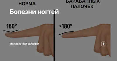 Какие болезни могут быть причиной некрасивых ногтей — Ferra.ru