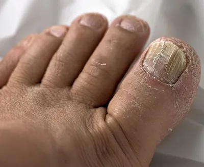 Симптомы онихомикоза — грибка ногтей |