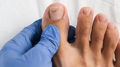Из-за чего ногти становятся ребристыми – что делать, способы лечения и  профилактики