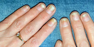 Деформация ногтя: причины и лечение - Клиника ТРИНИТИ (Москва)