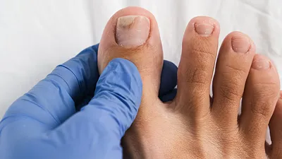 Онихолизис ногтей: виды, лечение, рекомендации