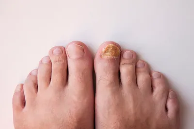 Что такое онихолизис, причины и лечение онихолизиса ногтей на руках и ногах  | STALEKS