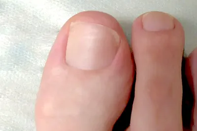 Грибковые заболевания на ногтях: признаки, причины и как их лечить?
