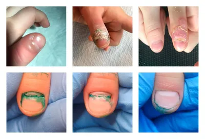 Инфекция кожи, вызвавшая отслойку ногтей у ребенка ✓ Авторские статьи  Клиники подологии Полёт в Москве