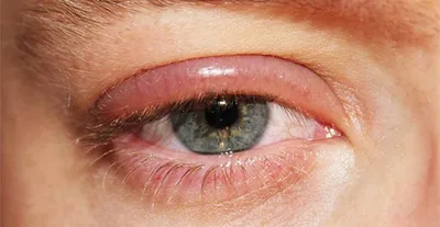 Болезни век, Diseases of Eyelids | Орган Зрения