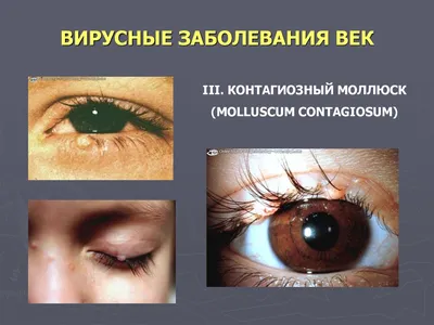Назвали самые распространенные аллергические болезни глаз - Здоровье 24