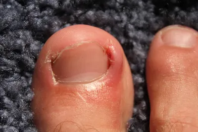 Болит большой палец на ноге возле ногтя фото фото