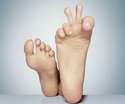 Перелом пальца на ноге: признаки, симптомы, лечение, сколько заживает