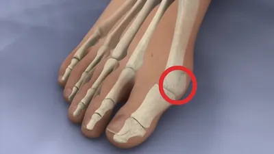 Халюс Вальгус - как лечить Hallux Valgus? Полезные статьи в блоге  Ортека.Life