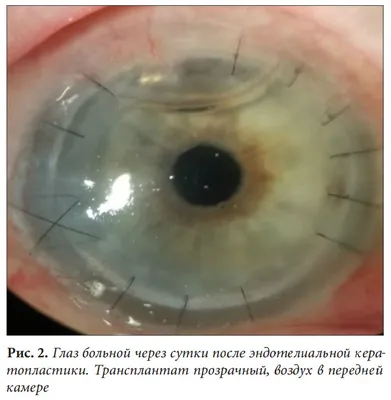 Из больного глаза вырывается зрение с воспаленными венами от инфекции  Стоковое Изображение - изображение насчитывающей кожа, возраст: 165234565