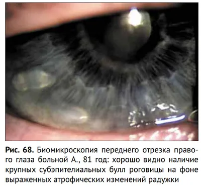 Тесное фотографии Больной зеленый глаз с кровеносными сосудами,  конюнктивит, воспаление Мешки под глазами. Стоковое Фото - изображение  насчитывающей глаза, оптический: 199206970