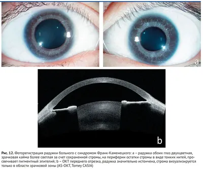 Красные глаза больного шизофренией …» — создано в Шедевруме