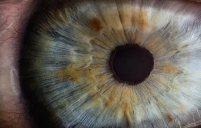 Рис. 68. Биомикроскопия переднего отрезка правого глаза больной А., 81…