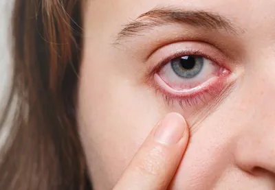 Воспаление Больного Человеческого Глаза С Блефаритом Симптомы Аллергии  Красные Вены Заболевания Глаз Усталость Или Аллергическая Инфек — стоковая  векторная графика и другие изображения на тему Глаз - iStock