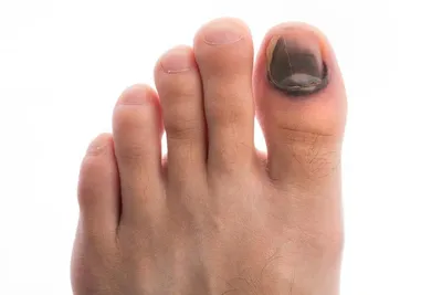 Nail_podolog - При некоторых заболеваниях ногтей пластины так  деформируются, что мешают нормально ходить и сильно снижают качество жизни.  Одна из таких болезней — онихогрифоз. Это состояние с тяжелым изменением  ногтевой пластины, когда