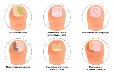 Грибковые болезни на ногах руках и ногтях