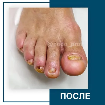 Онихолизис ногтей: виды, причины, симптомы и лечение. Как связаны  онихолизис и гель-лак?