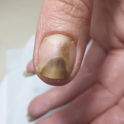 Лечение вросшего ногтя | Пикабу