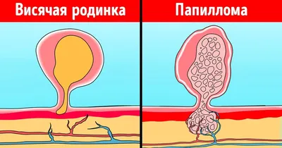 Дмитрий Ерин - Удаление бородавок / родинок происходит за 1 сеанс 🙌.  Родинки необходимо вначале проверить у дерматолога ☝️ Бородавки удаляются  без консультации врача 🤗. Запись по телефону : +38(063)-274-97-15 ☎️ Viber  Telegram WhatsApp | Facebook