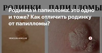 Родинки и папилломы на коже: как различить, почему они появились и как их  можно безопасно удалить и избежать перерождения