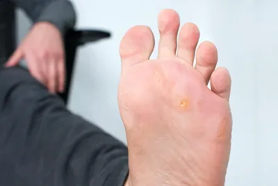 Бородавки на пальцах ног - YouTube