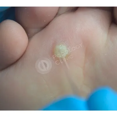 обыкновенный бородавка на спинной поверхности среднего пальца в азиатском  мианмарском ребёнке. это небольшой рост с грубой текстур Стоковое Фото -  изображение насчитывающей изолировано, рука: 247385434