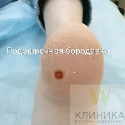 В Нижнем Новгороде врачи удалили вирусную бородавку мальчику из Европы