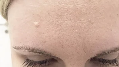 Удаление бородавок лазером на лице в СПб | Лазерный Доктор