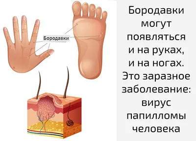 Бородавки на лице: причины, профилактика, лечение.