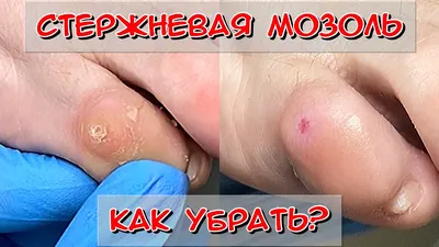 Мозоль на мизинце ноги доставляет много... - natali_nik_nails | Facebook