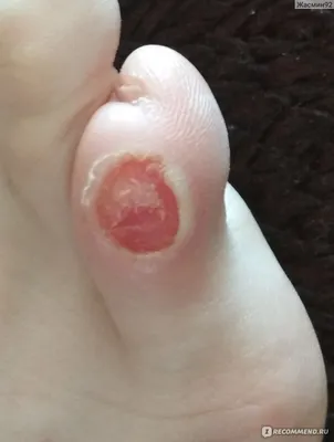 Бородавки на пальцах ног - YouTube