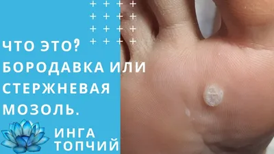 Бородавка- шипица на мизинце ноги - Вопрос дерматологу - 03 Онлайн