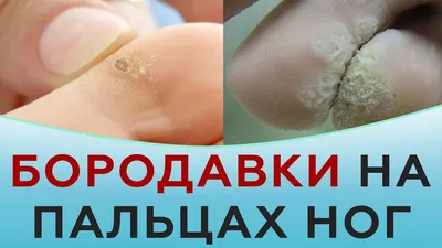 Лечение бородавок в Киеве — Derma.ua