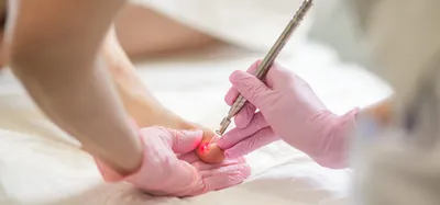 Удаление новообразований на коже - Beauty Clinic клиника врачебной  косметологии Тамбов