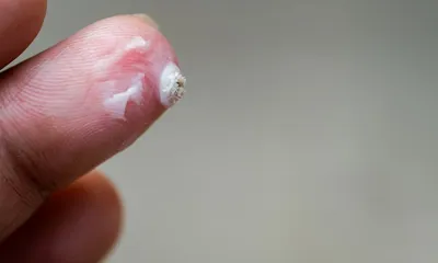 Бородавка на пальце у ребенка: причины, лечение и профилактика
