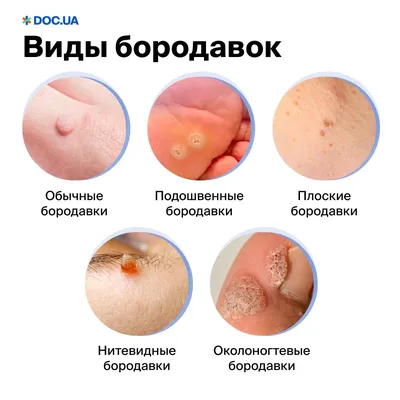 Лечение и удаление подошвенных бородавок | Подолог Алматы