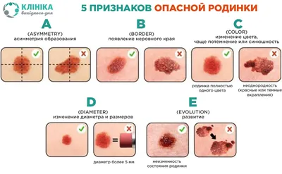 Папилломы, почему возникают, фото, когда необходимо удалять?