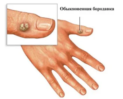 Большая бородавка кисти в процессе криодеструкции. Далее обмороженная  бородавка отпадает в течении 2-3-х недель без рубца | Instagram