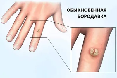 Как вылечить бородавку. Консервативные и малоинвазивные методики лечения