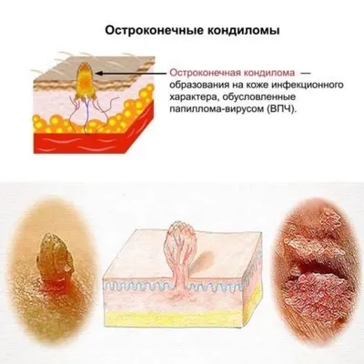 кондилома акуминат также известен как генитальный бородавки световой  микрограф Стоковое Изображение - изображение насчитывающей микроскопическо,  онкология: 228341883