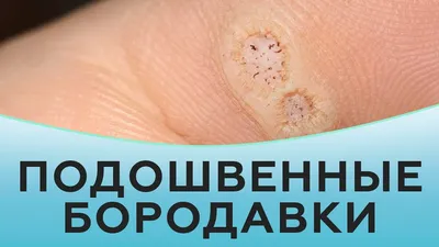Лазерное удаление новообразований кожи в Минске