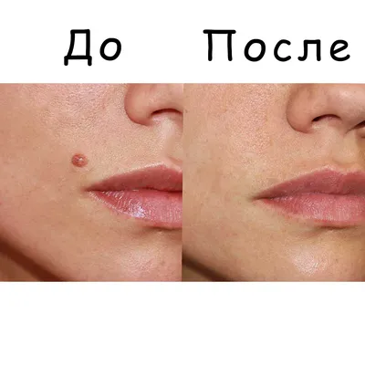 После удаления бородавок жидким азотом: дерматолог в Москве.