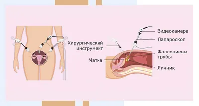 Электрокоагуляция в Москве, удаление доброкачественных новообразований кожи  | Удаление электрокоагуляцией родинок, папиллом, бородавок