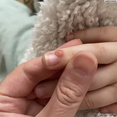 Удаление папиллом, бородавок и родинок криотерапией (жидким азотом) -  «Бесплатное удаление бородавки на пальце у ребенка. Фото по дням.» | отзывы